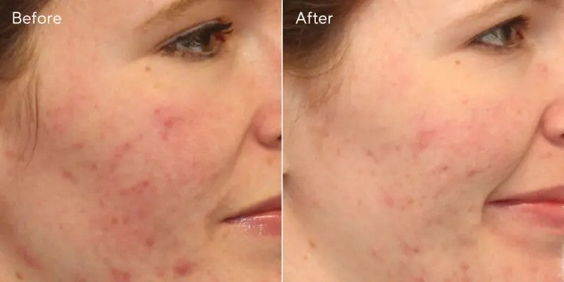 Clarifying cleanser - Limpiador aclarante para el control del acné