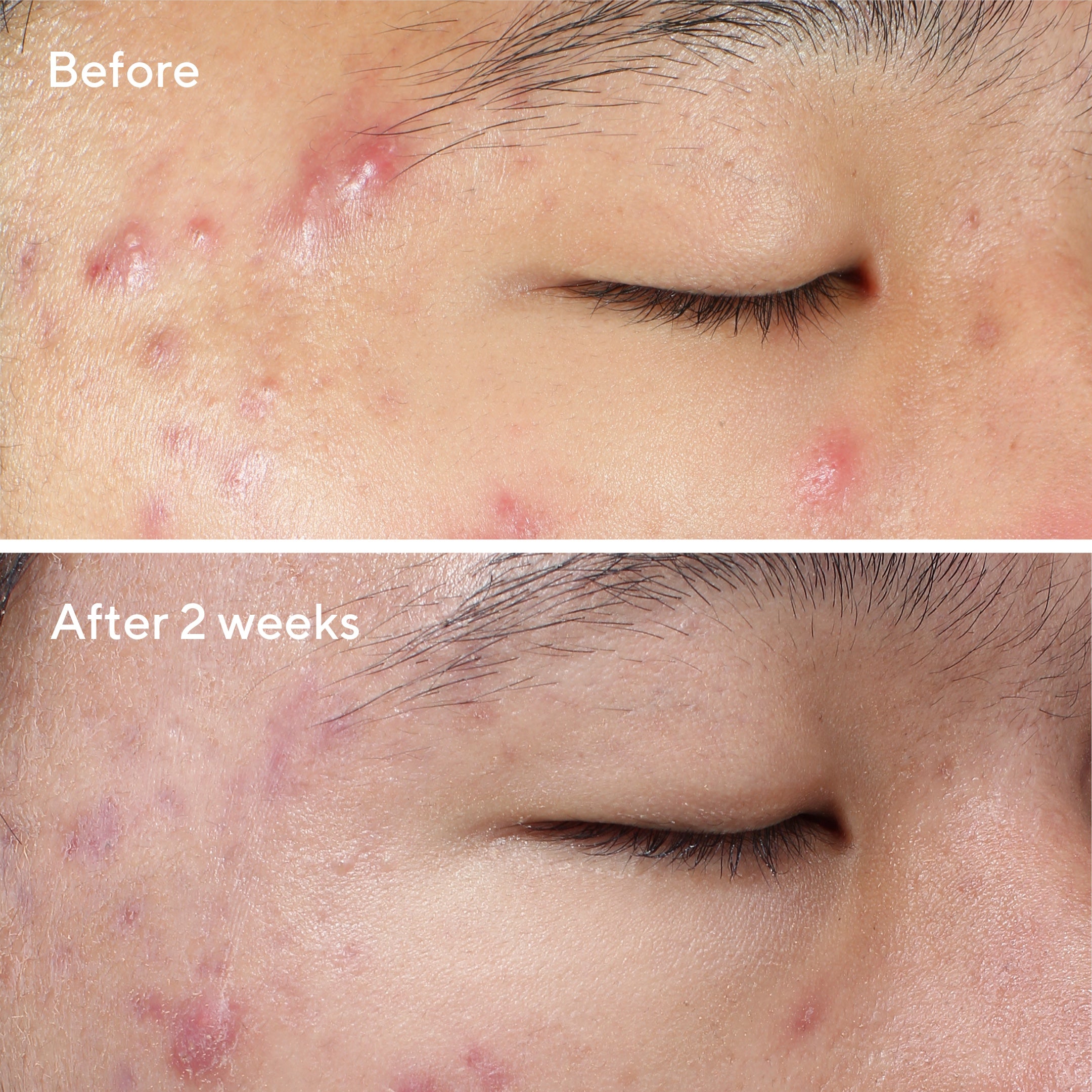 Deep Relief Blemish Treatment - Tratamiento para acné severo
