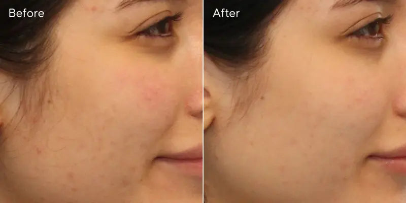 Clarifying cleanser - Limpiador aclarante para el control del acné