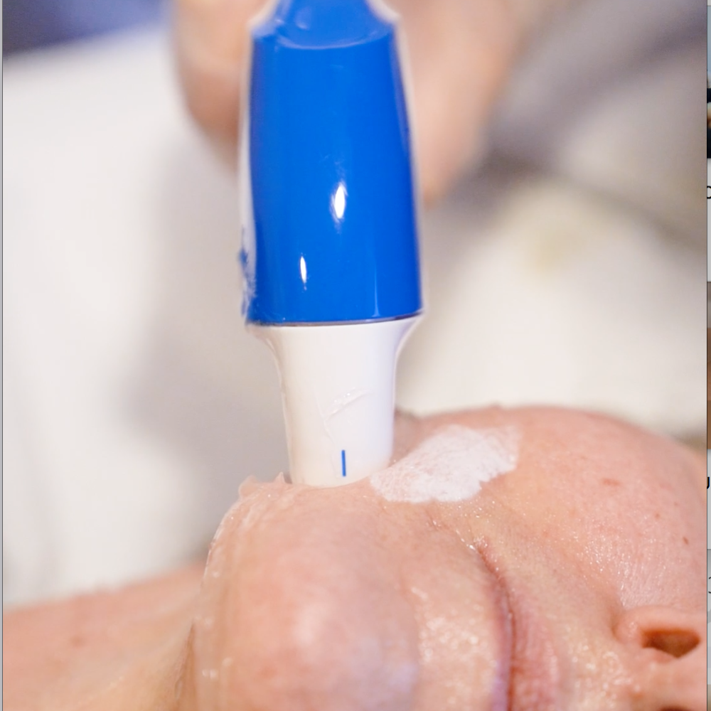 Protocolo lifting: Ultraformer MPT + Virtue RF