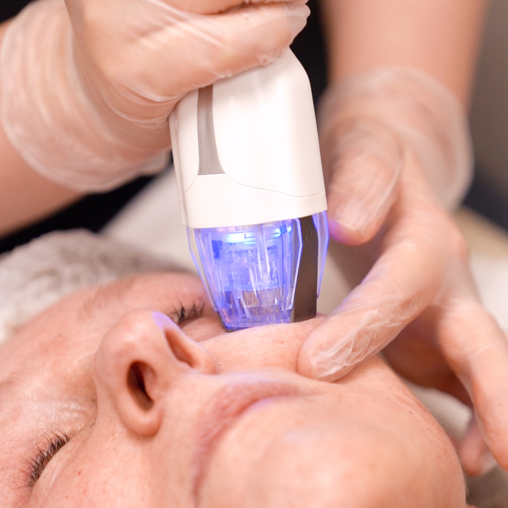 Protocolo lifting: Ultraformer MPT + Virtue RF