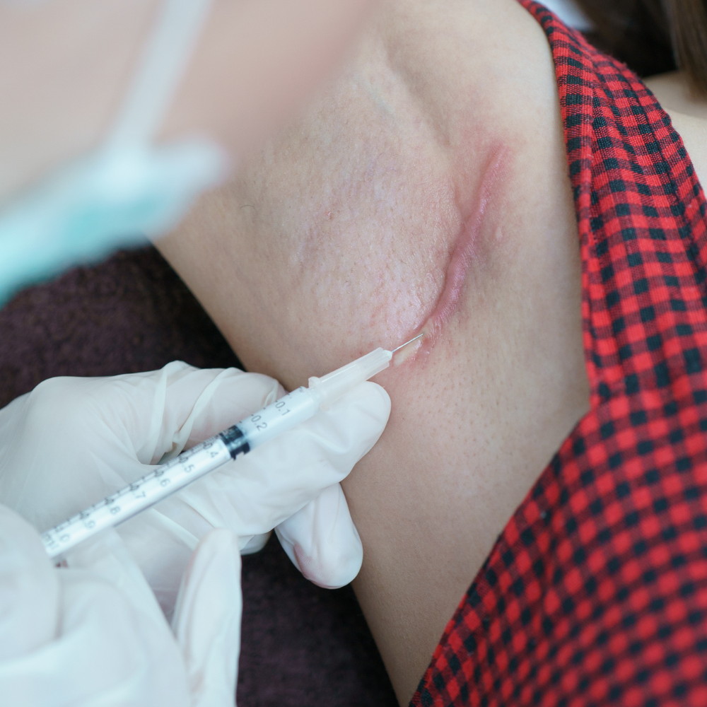 Infiltraciones dermatológicas