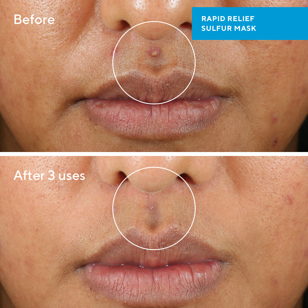 Rapid Relief Sulfur Mask - Mascara para controlar la oleosidad, acné y mejorar la piel